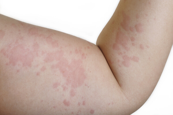 causes skin rashes that itch