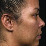 Thermage Before & After Patient #7490