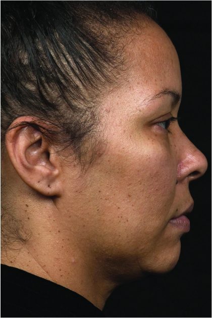 Thermage Before & After Patient #7490