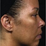 Thermage Before & After Patient #7490