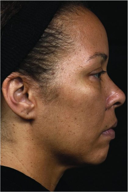 Thermage Before & After Patient #7490