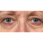 Thermage Before & After Patient #7491