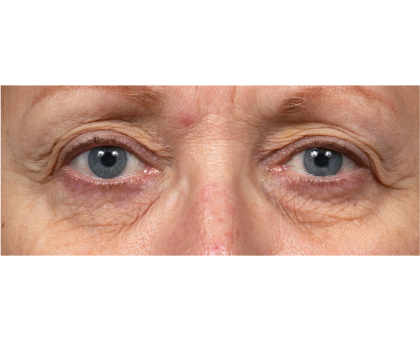 Thermage Before & After Patient #7491