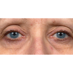 Thermage Before & After Patient #7491