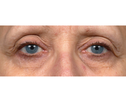 Thermage Before & After Patient #7491