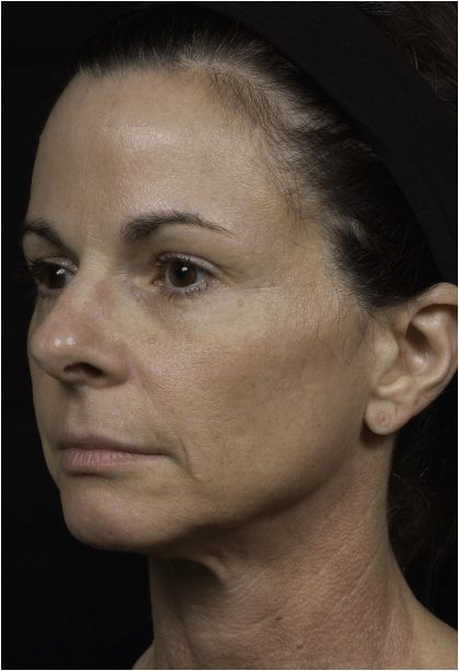 Thermage Before & After Patient #7493