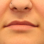 Juvederm Volbella Before & After Patient #7584