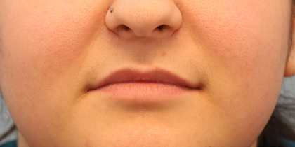 Juvederm Volbella Before & After Patient #7584