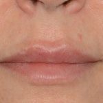 Juvederm Volbella Before & After Patient #7581