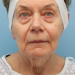 Mini Facelift Before & After Patient #7590