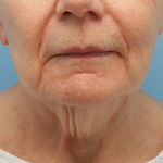 Neck Lift Before & After Patient #7593