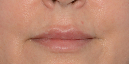 Juvederm Volbella Before & After Patient #7581