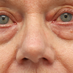 Lower Blepharoplasty Before & After Patient #7596