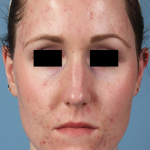 PicoSure Focus Before & After Patient #7603