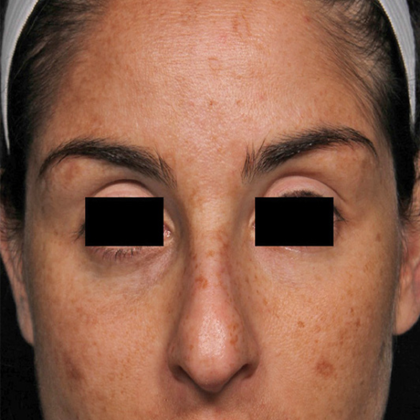 PicoSure Focus Before & After Patient #7607