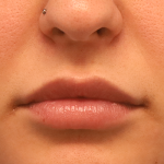 Juvederm Volbella Before & After Patient #7584