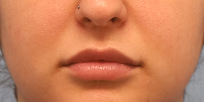 Juvederm Volbella Before & After Patient #7584