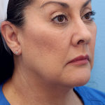 Juvederm Voluma Before & After Patient #7587