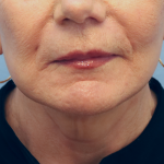 Neck Lift Before & After Patient #7593