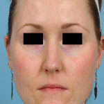 PicoSure Focus Before & After Patient #7603