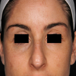 PicoSure Focus Before & After Patient #7607