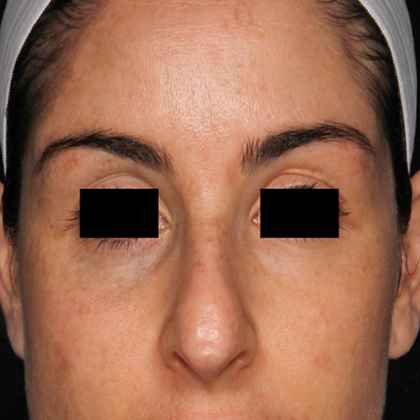 PicoSure Focus Before & After Patient #7607