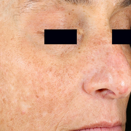 PicoSure Focus Before & After Patient #7618