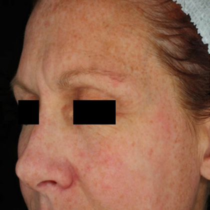 PicoSure Focus Before & After Patient #7612