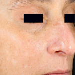 PicoSure Focus Before & After Patient #7618