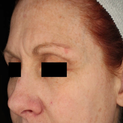 PicoSure Focus Before & After Patient #7612